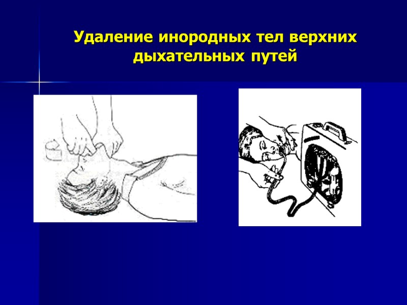 Удаление инородных тел верхних дыхательных путей Удаление инородных тел верхних дыхательных путей